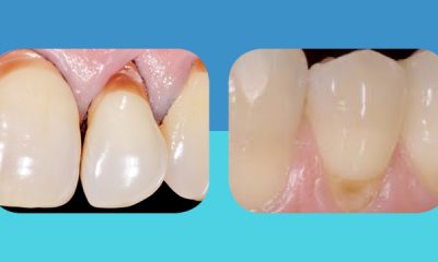 Lesioni non cariose del colletto dentale | I consigli dello studio dentistico Pelizzoni